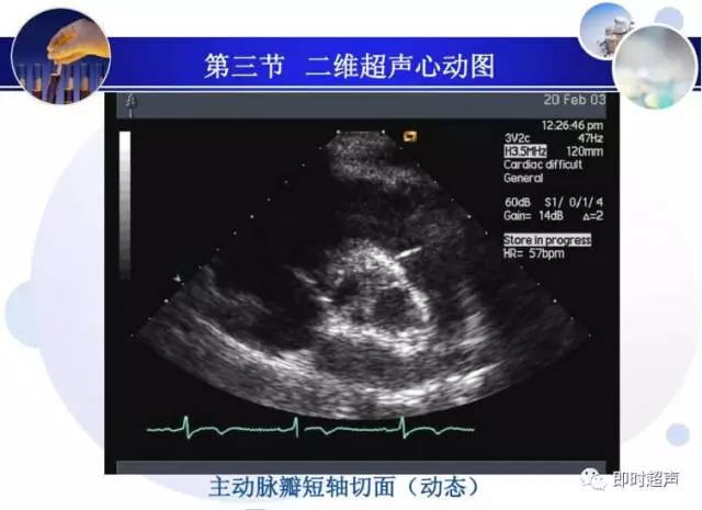 正常心脏超声诊断