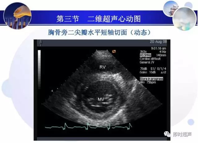 正常心脏超声诊断