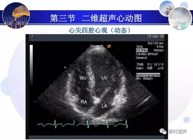 正常心脏超声诊断