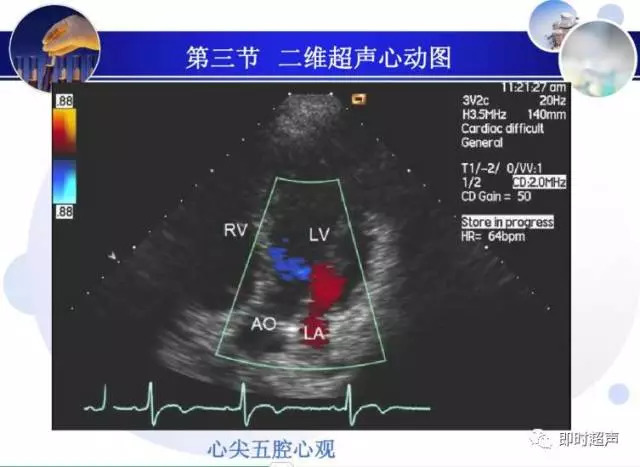 正常心脏超声诊断