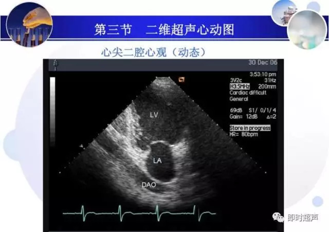 正常心脏超声诊断