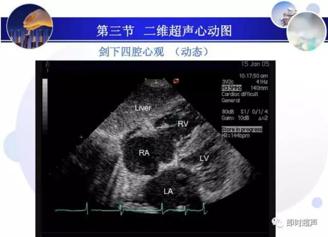 正常心脏超声诊断