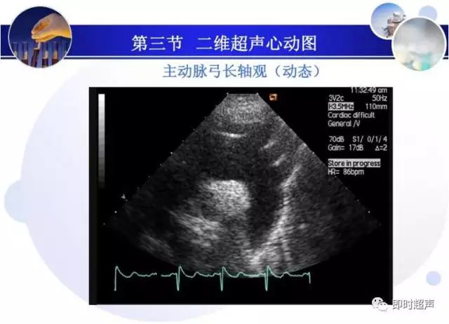 正常心脏超声诊断