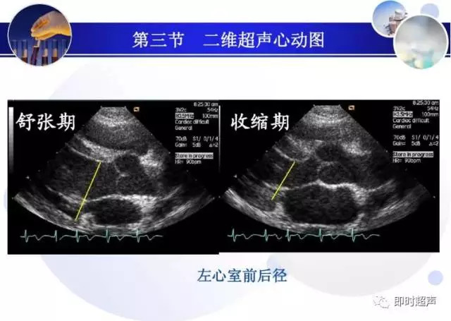 正常心脏超声诊断