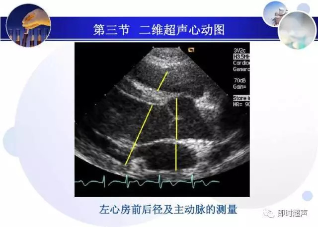 正常心脏超声诊断