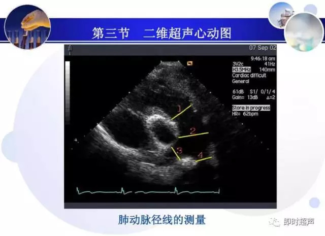 正常心脏超声诊断