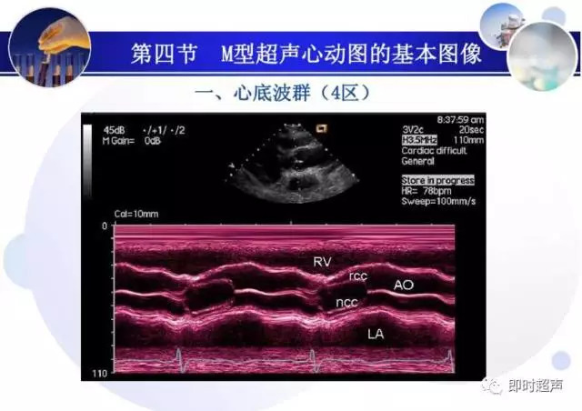 正常心脏超声诊断