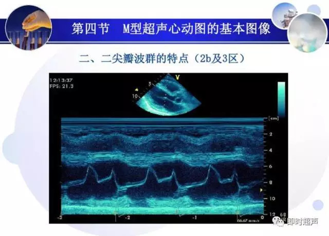 正常心脏超声诊断