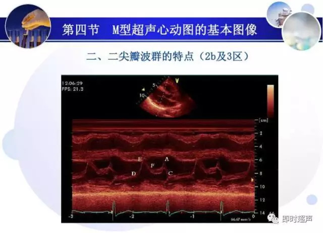 正常心脏超声诊断