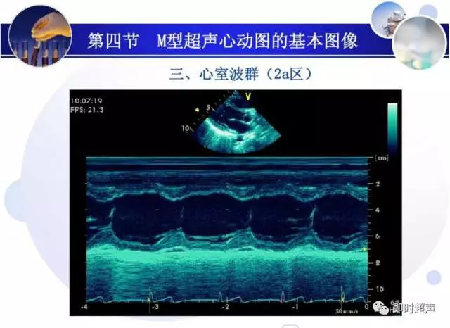 正常心脏超声诊断