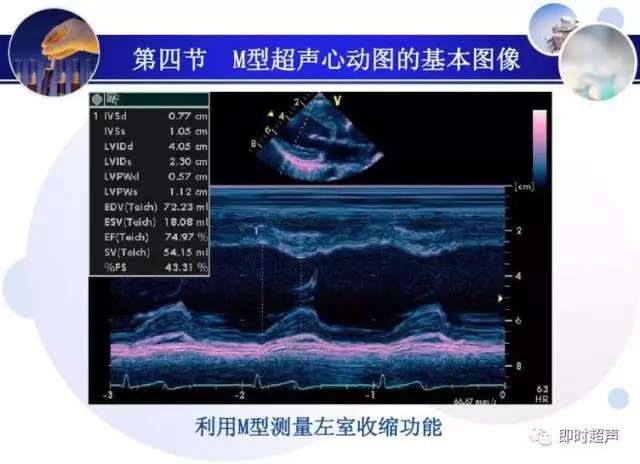 正常心脏超声诊断