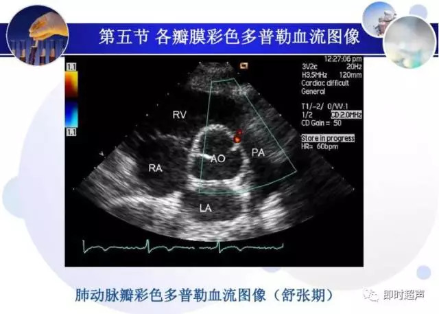 正常心脏超声诊断