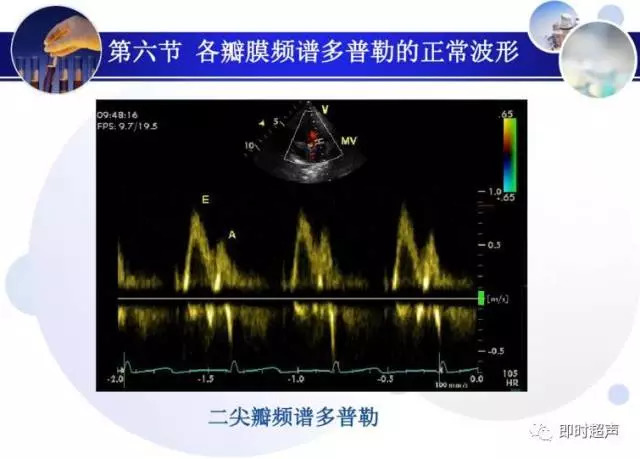 正常心脏超声诊断