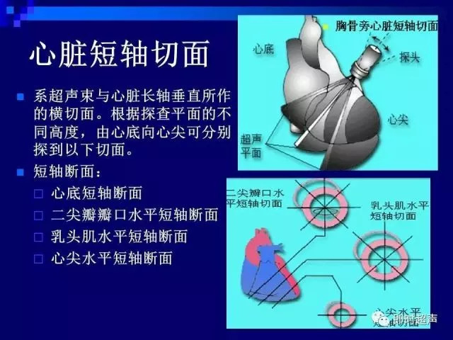 心脏超声解剖及正常声像图