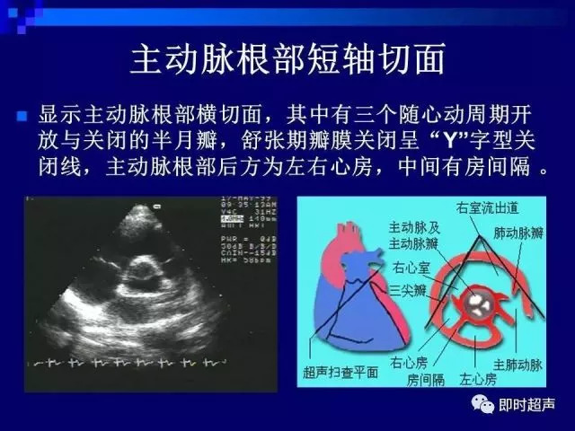 心脏超声解剖及正常声像图