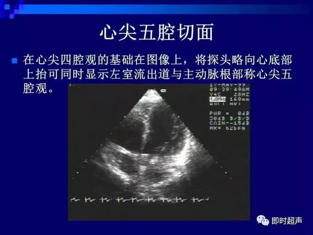 心脏超声解剖及正常声像图