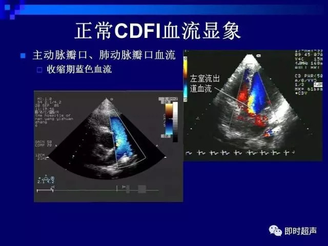 心脏超声解剖及正常声像图