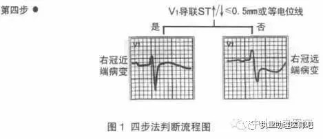 急性心肌梗死的心电图快速定位及临床意义