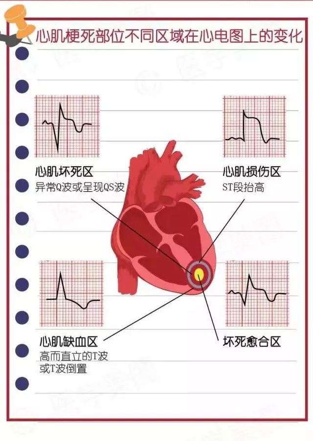 简易心电图教程（二）：如何看心肌梗死心电图