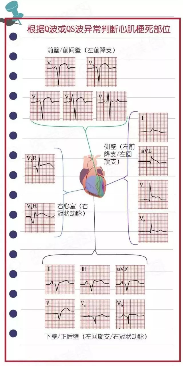 简易心电图教程（二）：如何看心肌梗死心电图