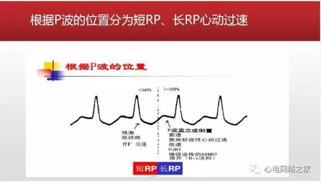 【课件】短RP窄QRS心动过速体表心电图的诊断与鉴别诊断