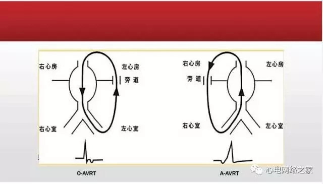 【课件】短RP窄QRS心动过速体表心电图的诊断与鉴别诊断