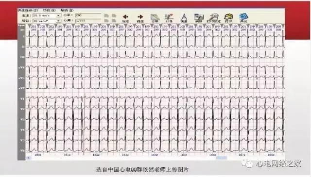 【课件】短RP窄QRS心动过速体表心电图的诊断与鉴别诊断