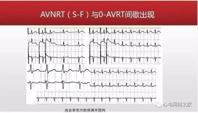 【课件】短RP窄QRS心动过速体表心电图的诊断与鉴别诊断