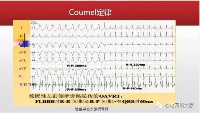 【课件】短RP窄QRS心动过速体表心电图的诊断与鉴别诊断