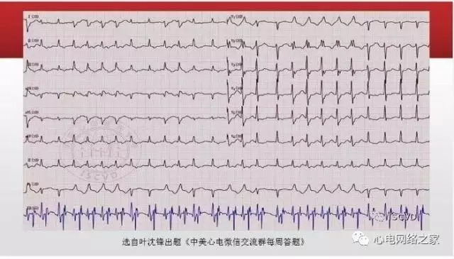 【课件】短RP窄QRS心动过速体表心电图的诊断与鉴别诊断