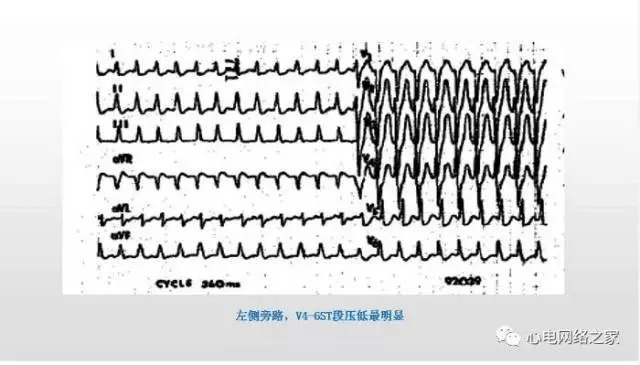 【课件】短RP窄QRS心动过速体表心电图的诊断与鉴别诊断