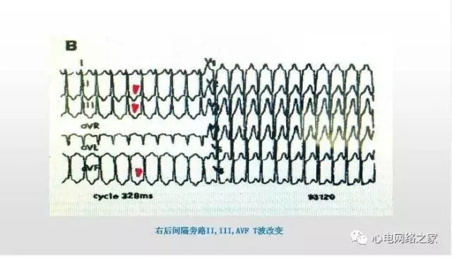 【课件】短RP窄QRS心动过速体表心电图的诊断与鉴别诊断