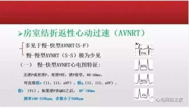 【课件】短RP窄QRS心动过速体表心电图的诊断与鉴别诊断