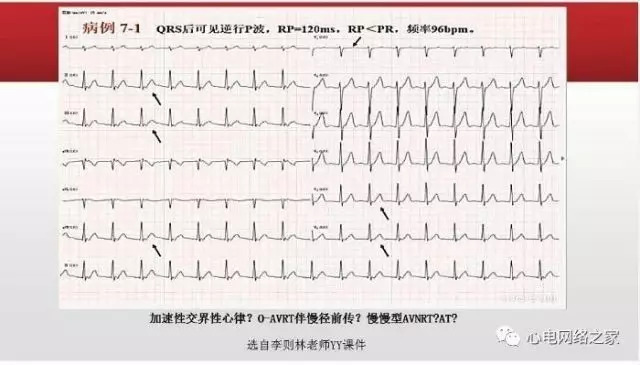 【课件】短RP窄QRS心动过速体表心电图的诊断与鉴别诊断