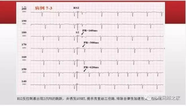 【课件】短RP窄QRS心动过速体表心电图的诊断与鉴别诊断