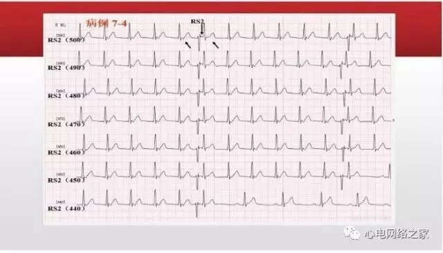 【课件】短RP窄QRS心动过速体表心电图的诊断与鉴别诊断