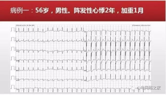 【课件】短RP窄QRS心动过速体表心电图的诊断与鉴别诊断