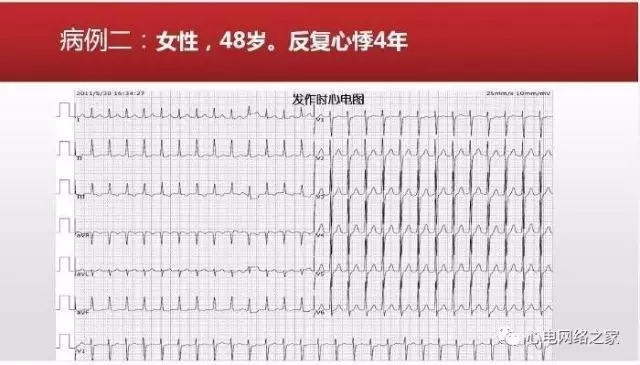 【课件】短RP窄QRS心动过速体表心电图的诊断与鉴别诊断