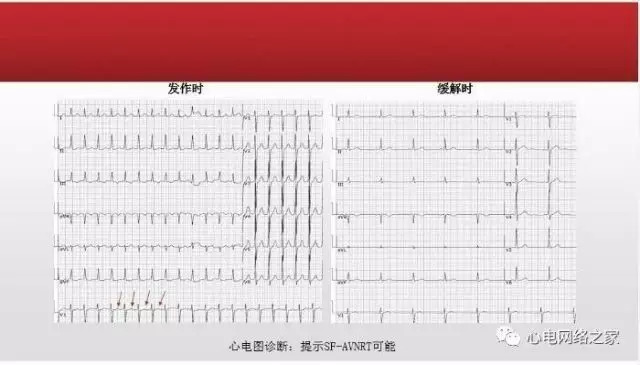 【课件】短RP窄QRS心动过速体表心电图的诊断与鉴别诊断