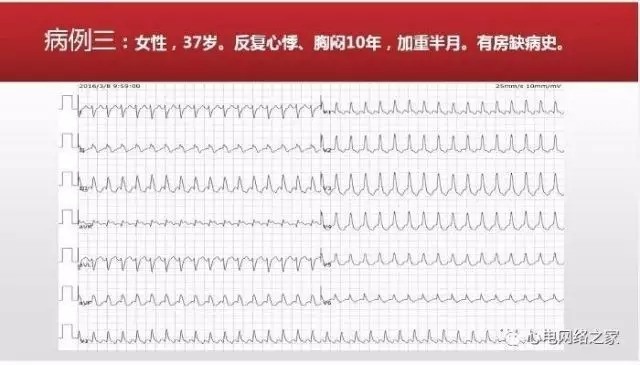 【课件】短RP窄QRS心动过速体表心电图的诊断与鉴别诊断