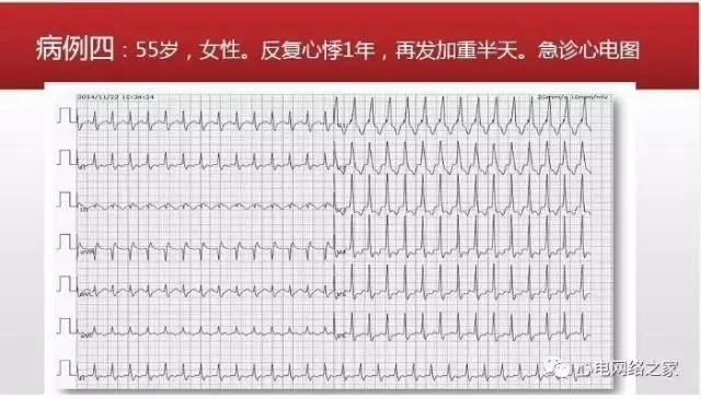 【课件】短RP窄QRS心动过速体表心电图的诊断与鉴别诊断