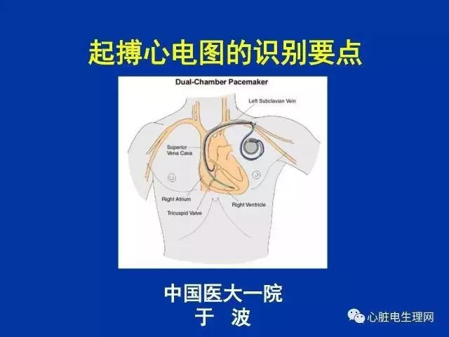 起搏心电图的识别要点