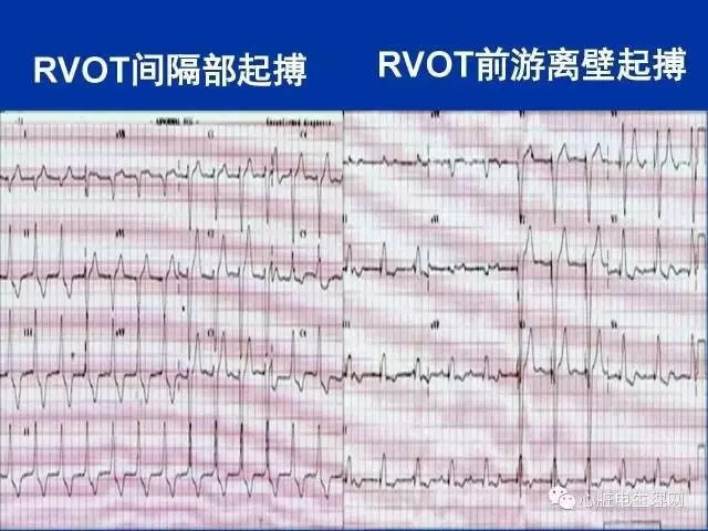 起搏心电图的识别要点