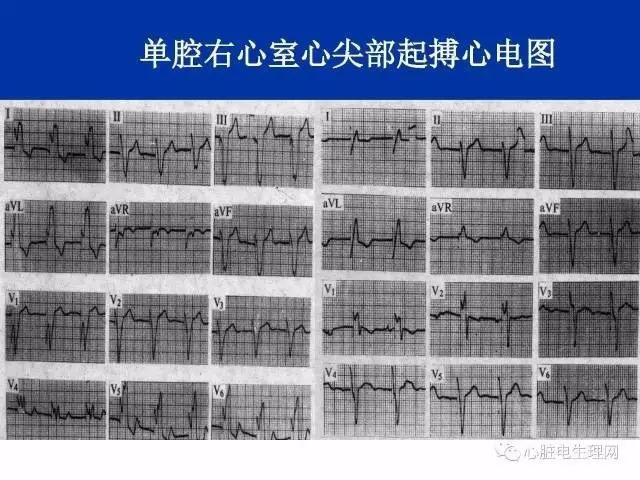 起搏心电图的识别要点