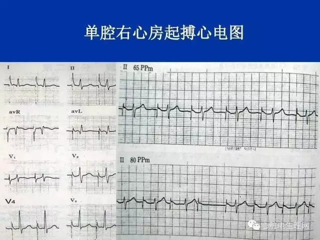 起搏心电图的识别要点