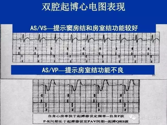 起搏心电图的识别要点