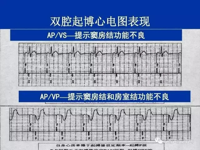 起搏心电图的识别要点