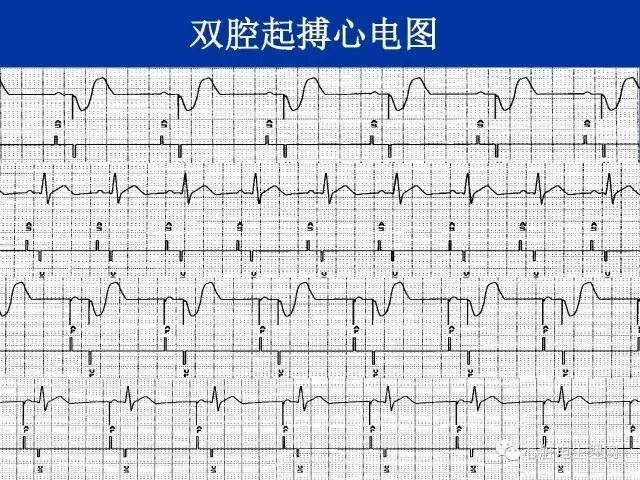 起搏心电图的识别要点