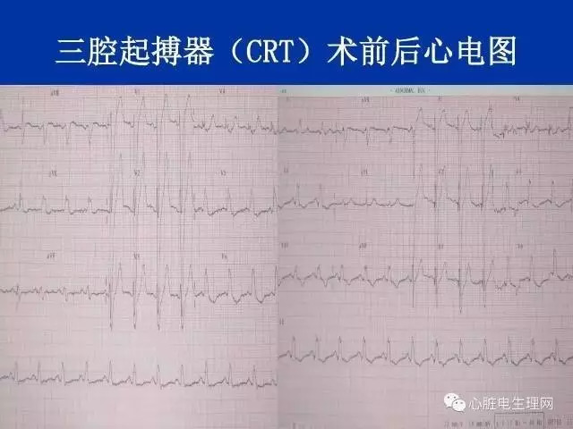 起搏心电图的识别要点