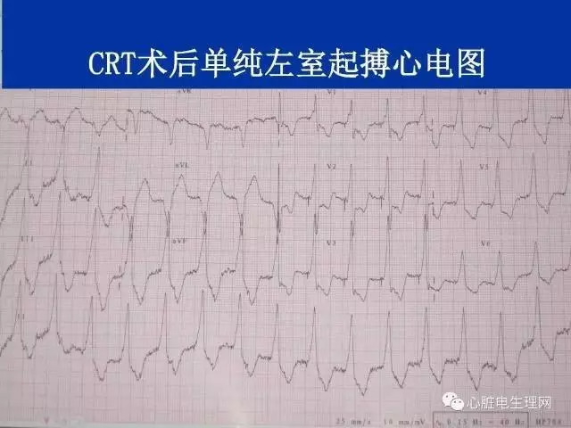 起搏心电图的识别要点